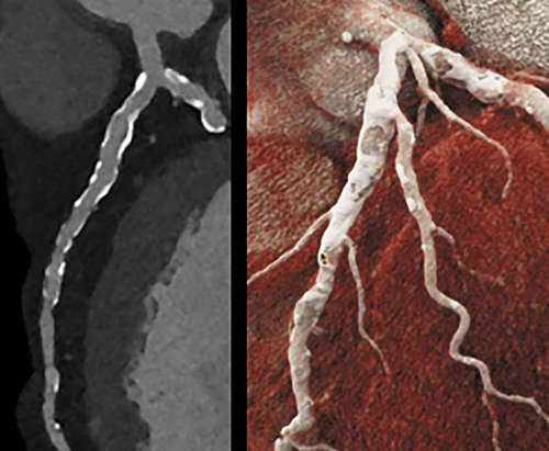 Kardiológiai CT kép 2: Keresztmetszeti nézet