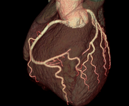 Kardiológiai CT kép 3: 3D rekonstrukció