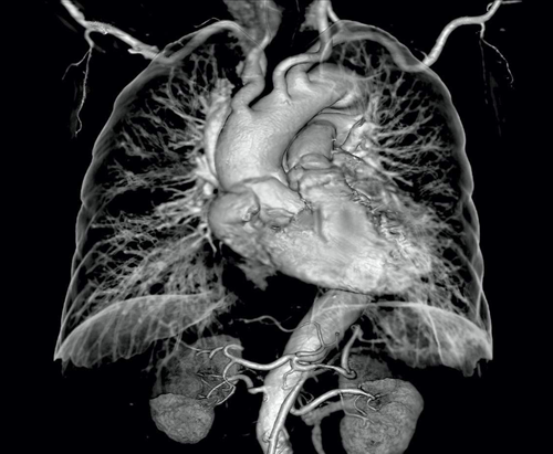 Kardiológiai CT kép 1: Angiográfiás nézet